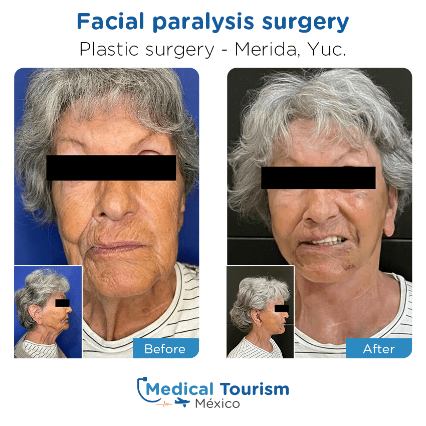 plastic surgery before and after of patients
                 in Mérida