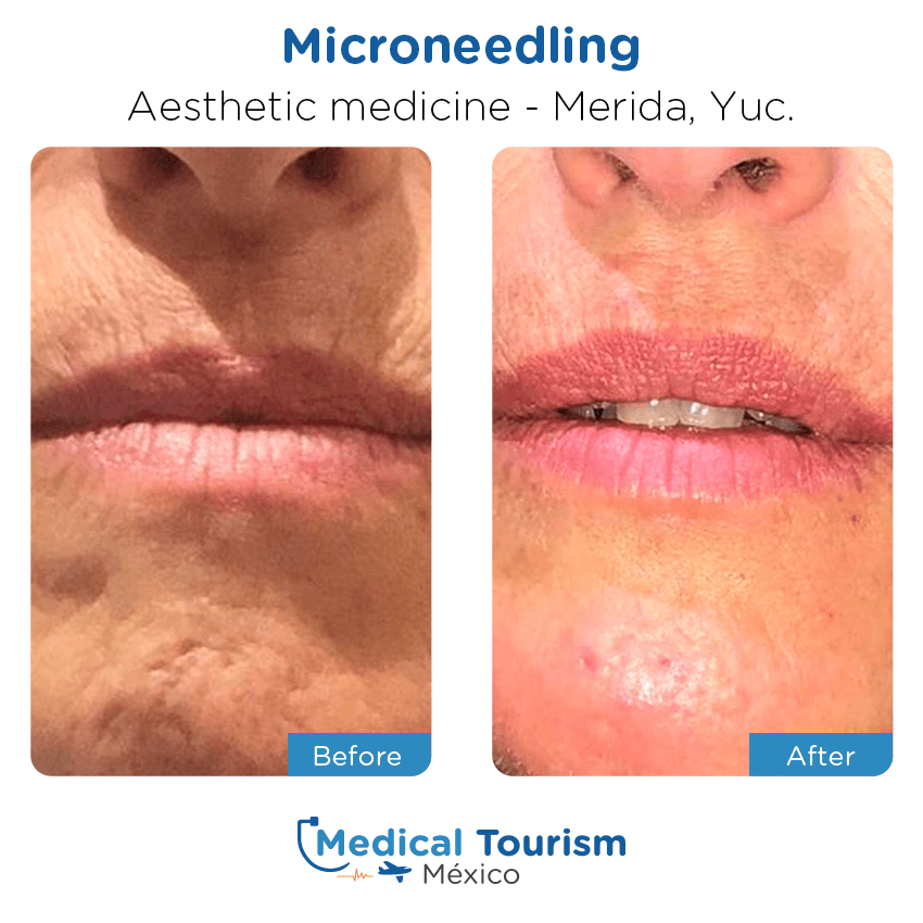 aesthetic medicine before and after of patients in Mérida
