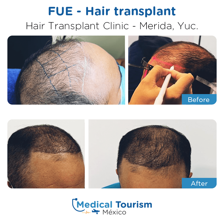 hair transplant clinic  before and after of patients in Mérida
