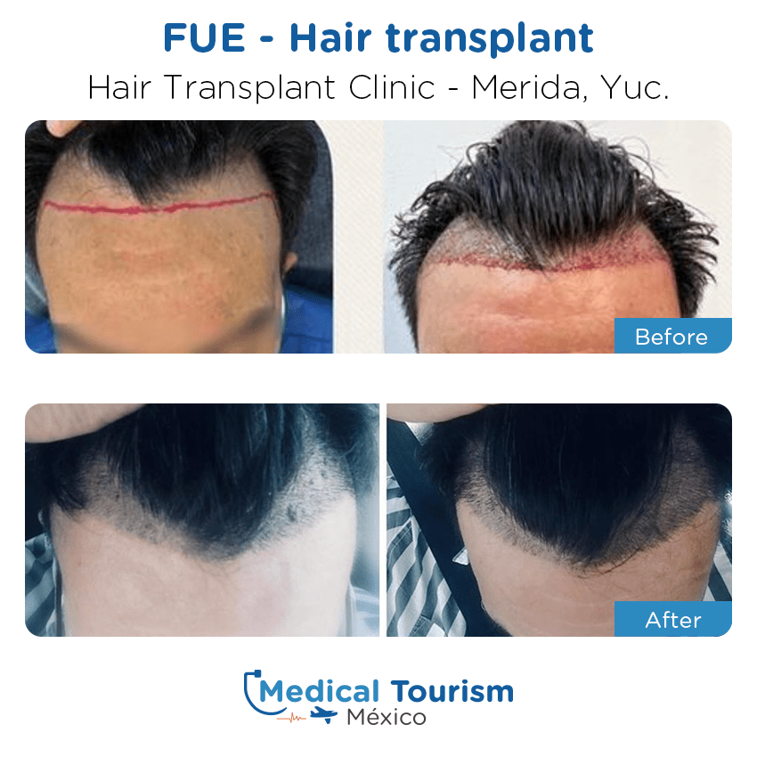 hair transplant clinic  before and after of patients
                 in Mérida