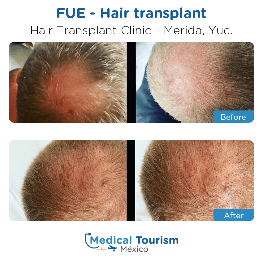 hair transplant clinic  before and after of patients
                 in Mérida