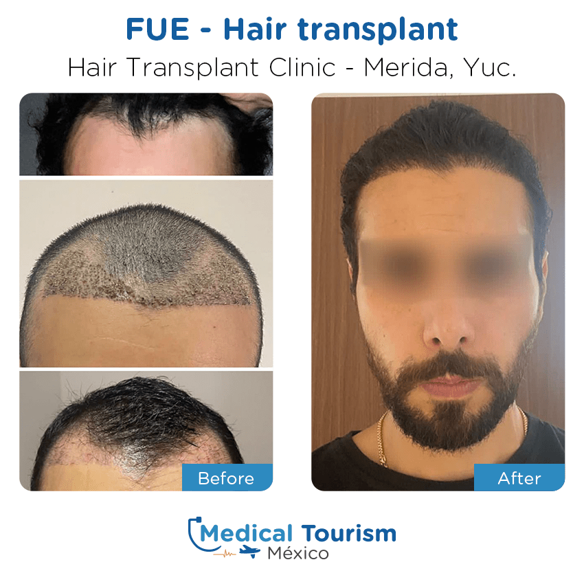 hair transplant clinic  before and after of patients in Mérida