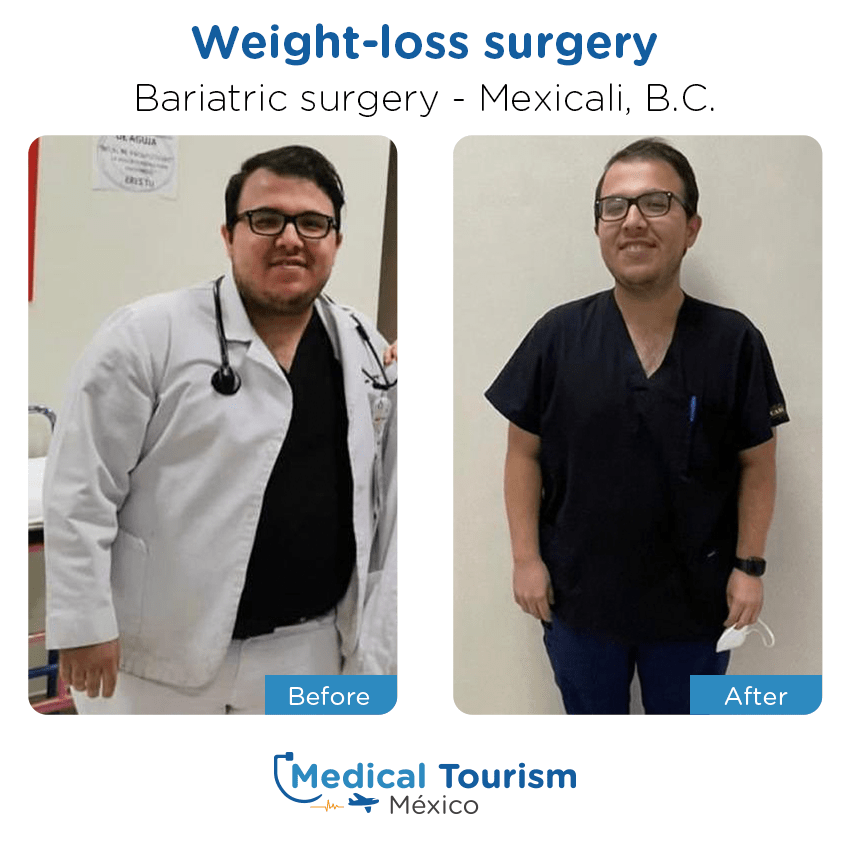 bariatric surgery before and after of patients in Mexicali