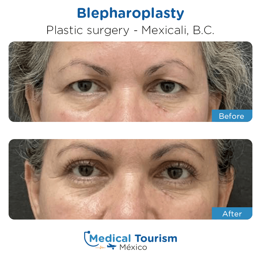 plastic surgery before and after of patients in Mexicali