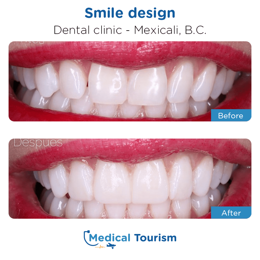 dental before and after of patients in Mexicali