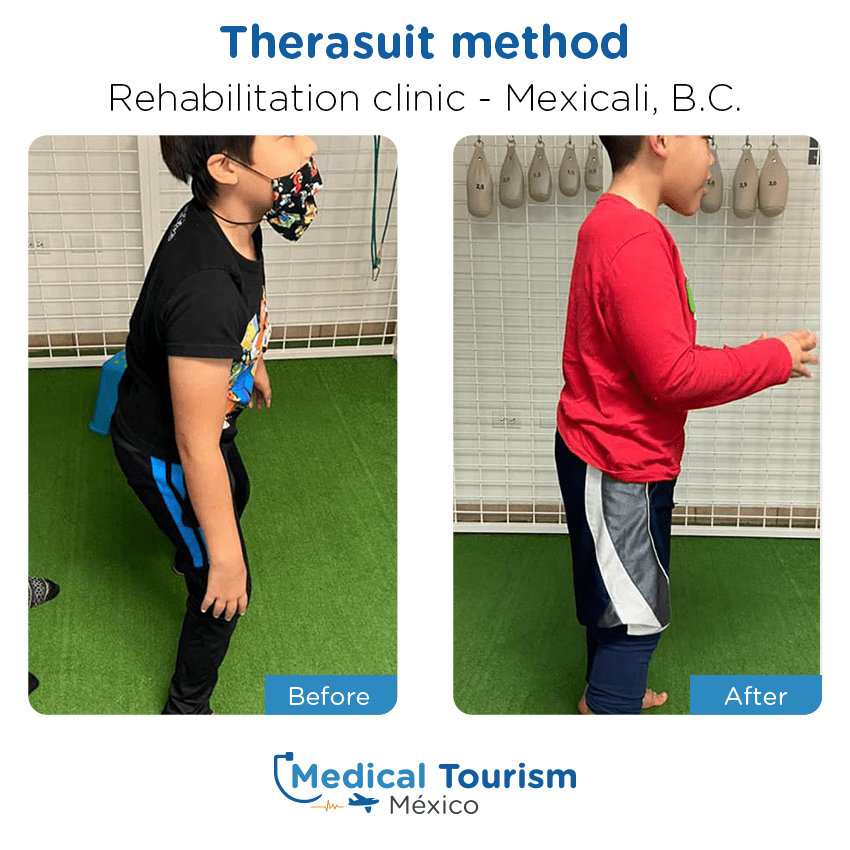 rehabilitation - physical therapy or chiropractic before and after of patients in Mexicali
