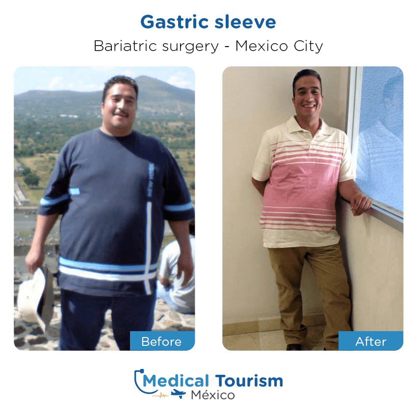 bariatric surgery before and after of patients in México City