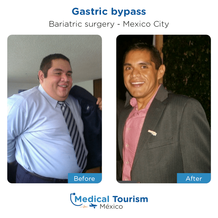 bariatric surgery before and after of patients
                 in México City