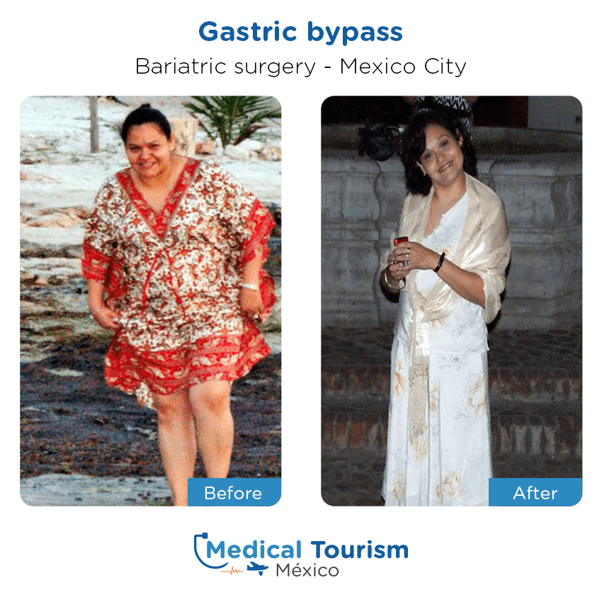 bariatric surgery before and after of patients
                 in México City
