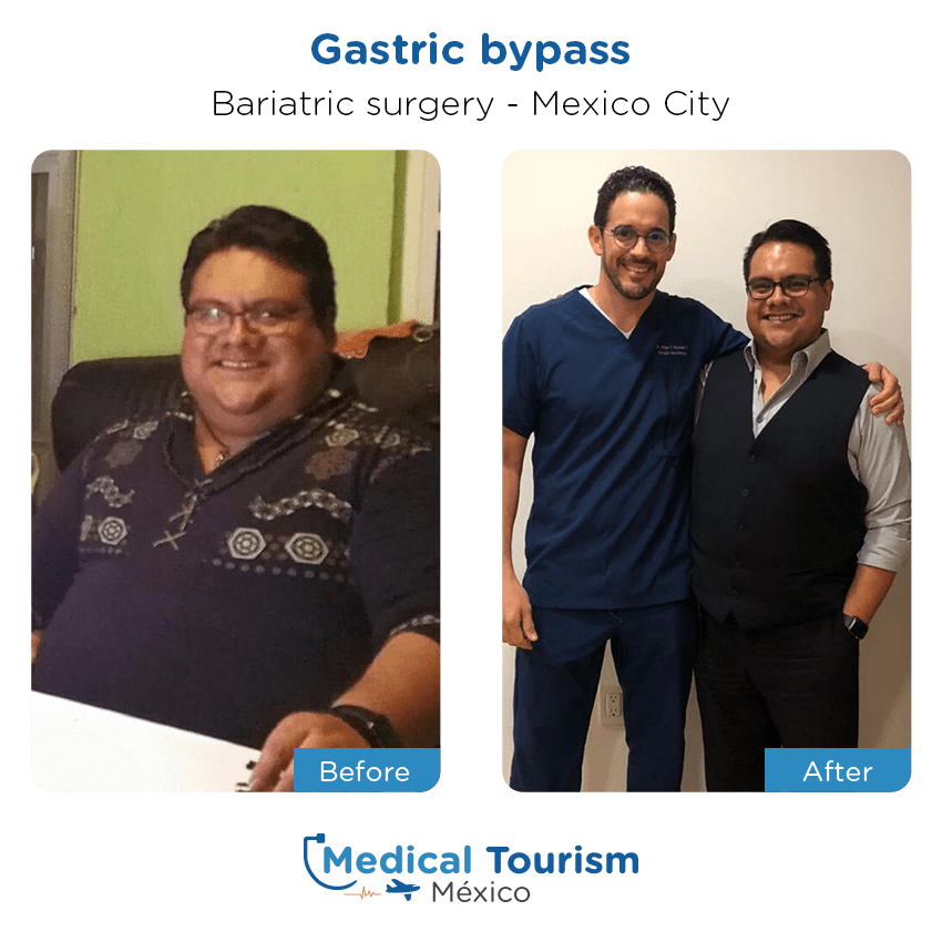 bariatric surgery before and after of patients in México City