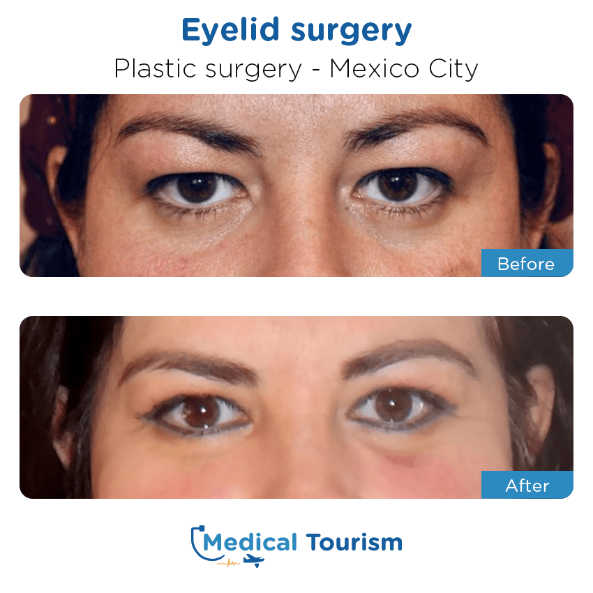 plastic surgery before and after of patients in México City