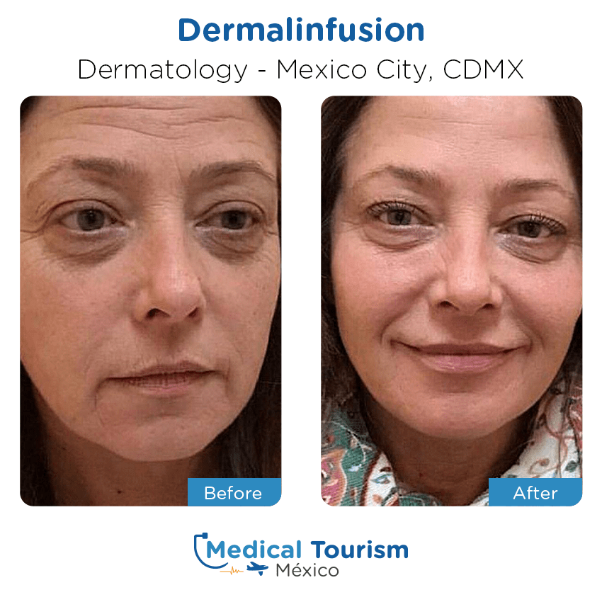 Patient before and after medical tourism
