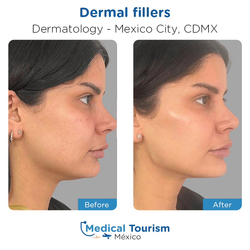dermatology before and after of patients in México City