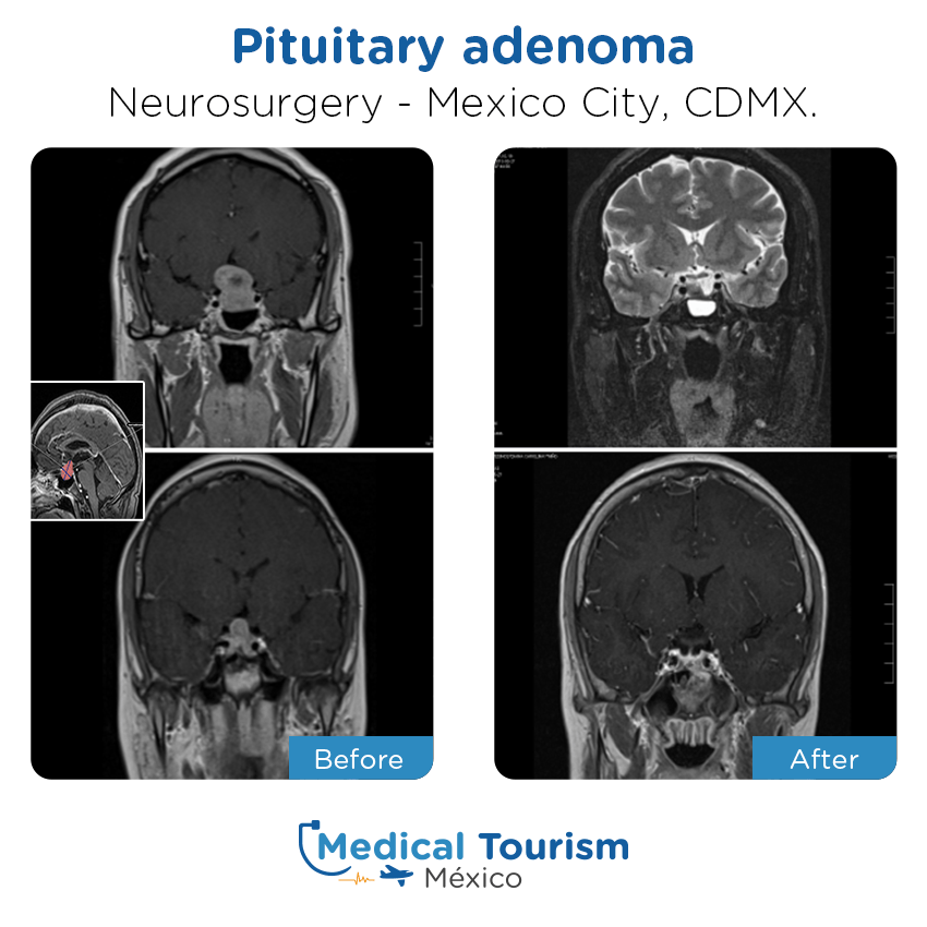 neurosurgery before and after of patients in México City