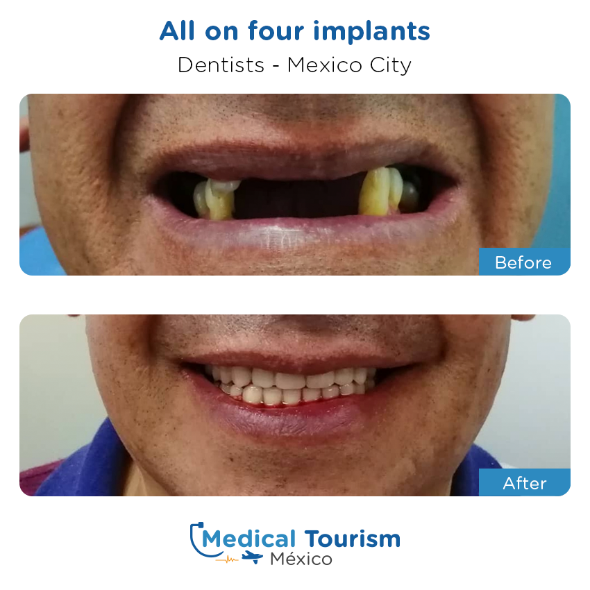 dental before and after of patients in México City