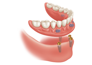 Illustrative image for snap on dentures procedure