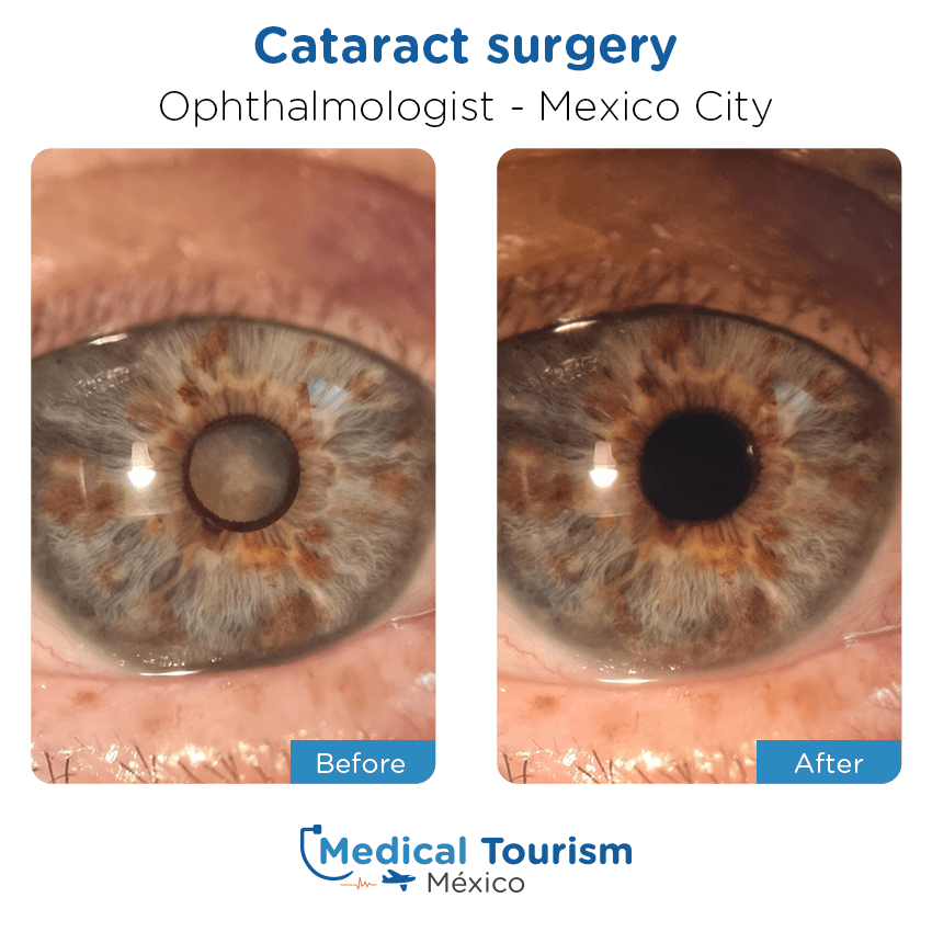 ophthalmology before and after of patients in México City