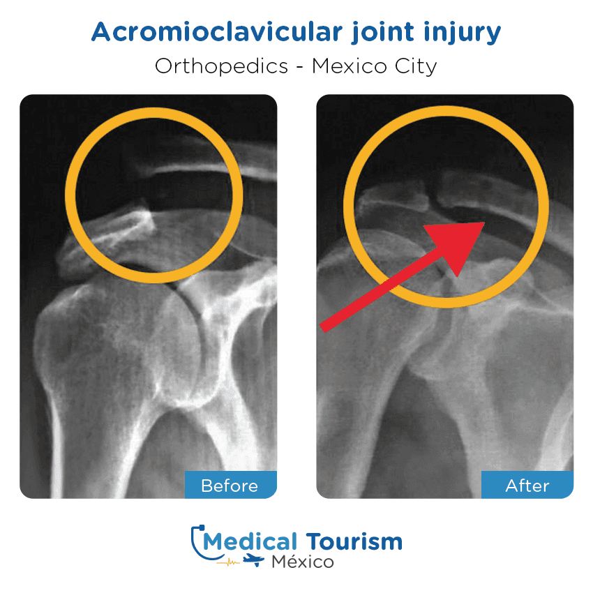 orthopedic before and after of patients in México City