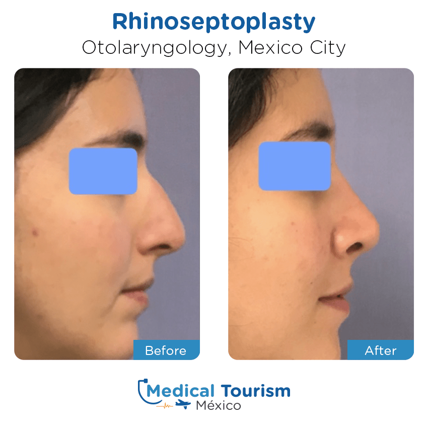 otolaryngology - ENT before and after of patients in México City