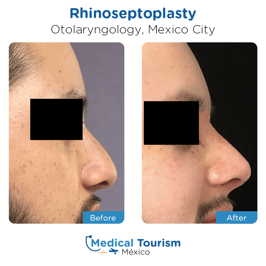 otolaryngology - ENT before and after of patients in México City