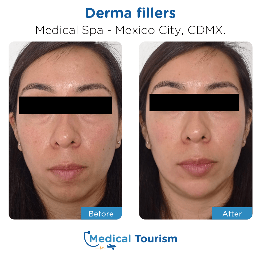 aesthetic medicine before and after of patients in México City