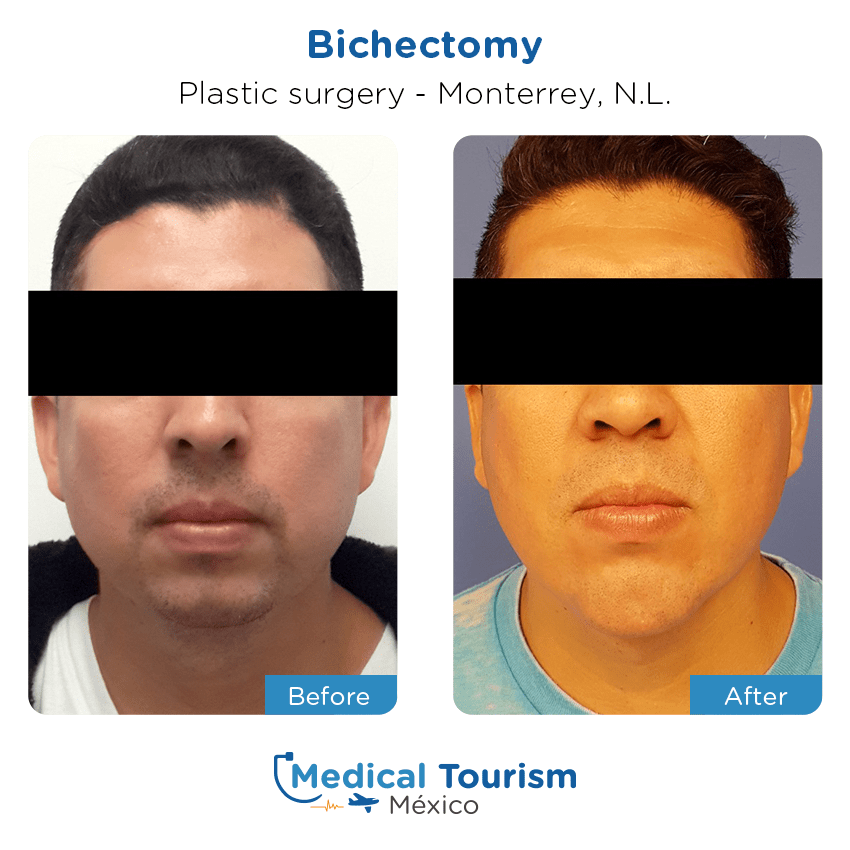 plastic surgery before and after of patients
                 in Monterrey
