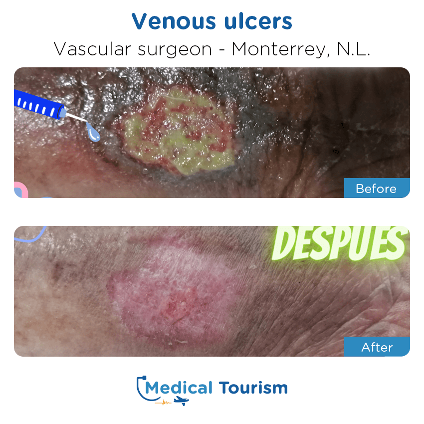 vascular surgery clinic before and after of patients in Monterrey