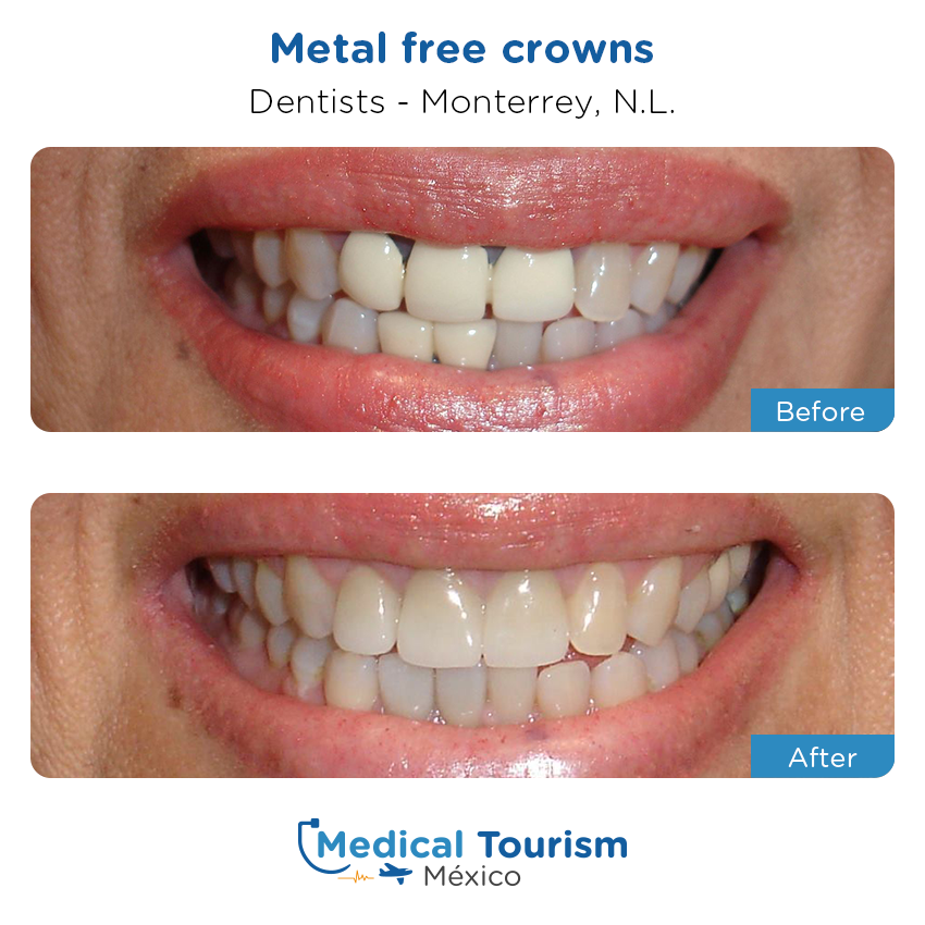 dental before and after of patients
                 in Monterrey