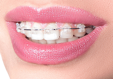 Smile showing teeth with ceramic braces