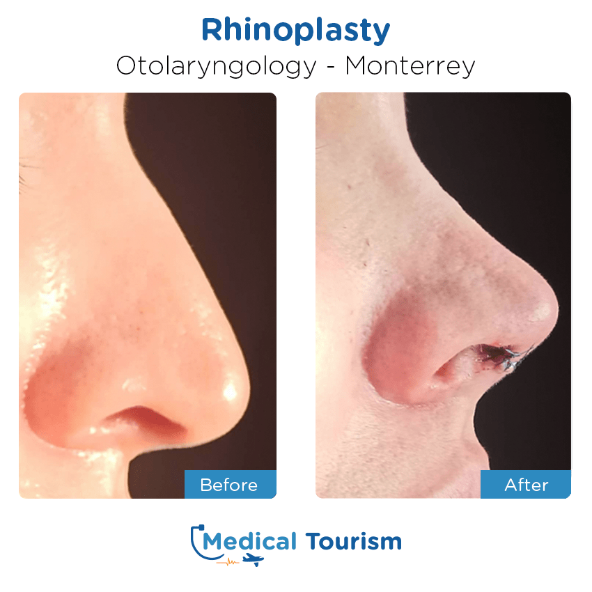 otolaryngology - ENT before and after of patients in Monterrey
