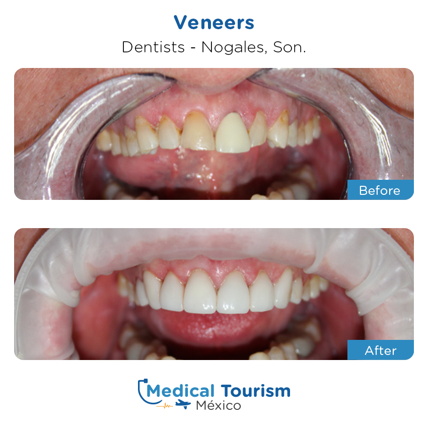 dental before and after of patients
                 in Nogales
