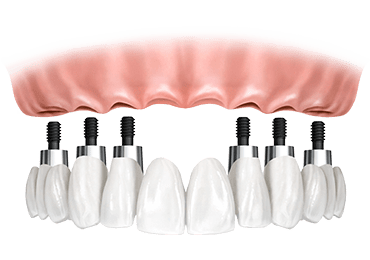 Illustrative image for all on six implants procedure