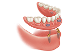 snap on denture over four implants