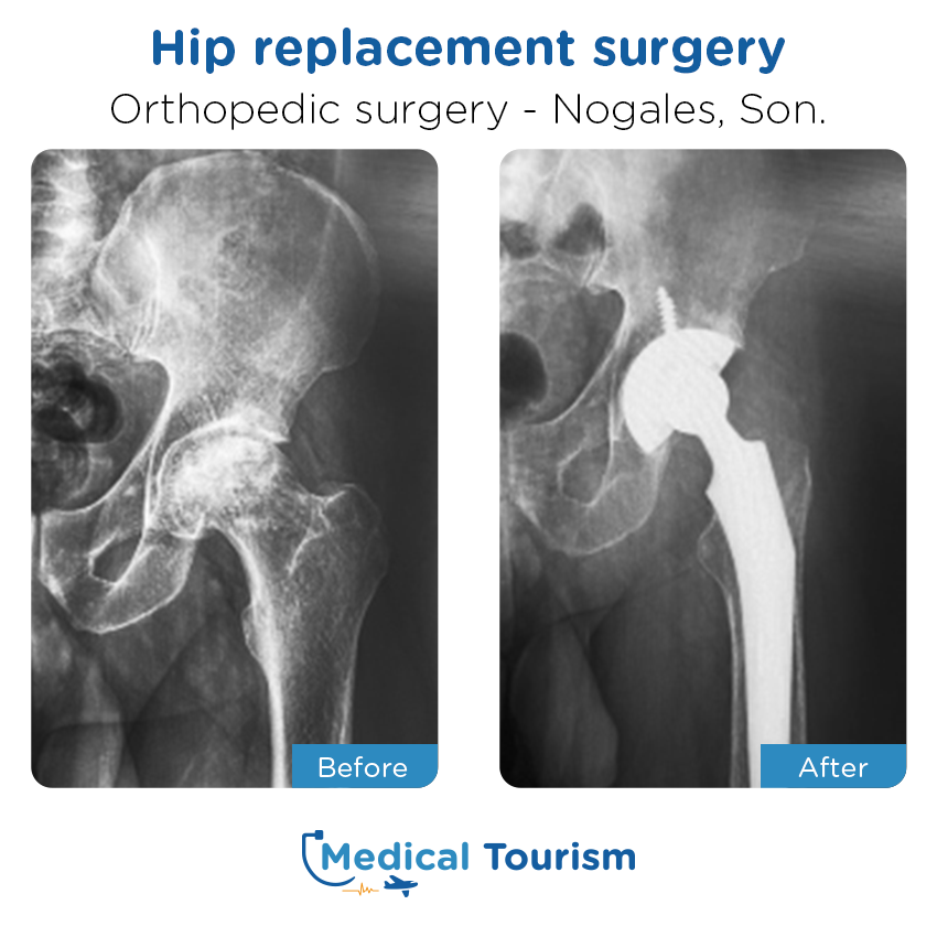 orthopedic before and after of patients in Nogales