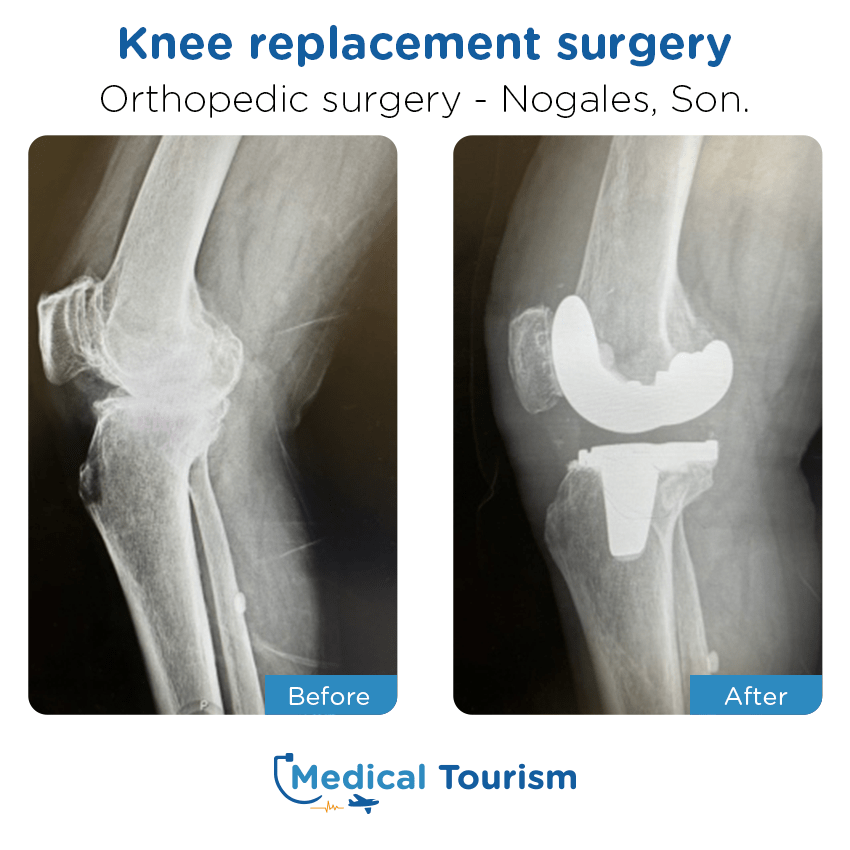 orthopedic before and after of patients in Nogales