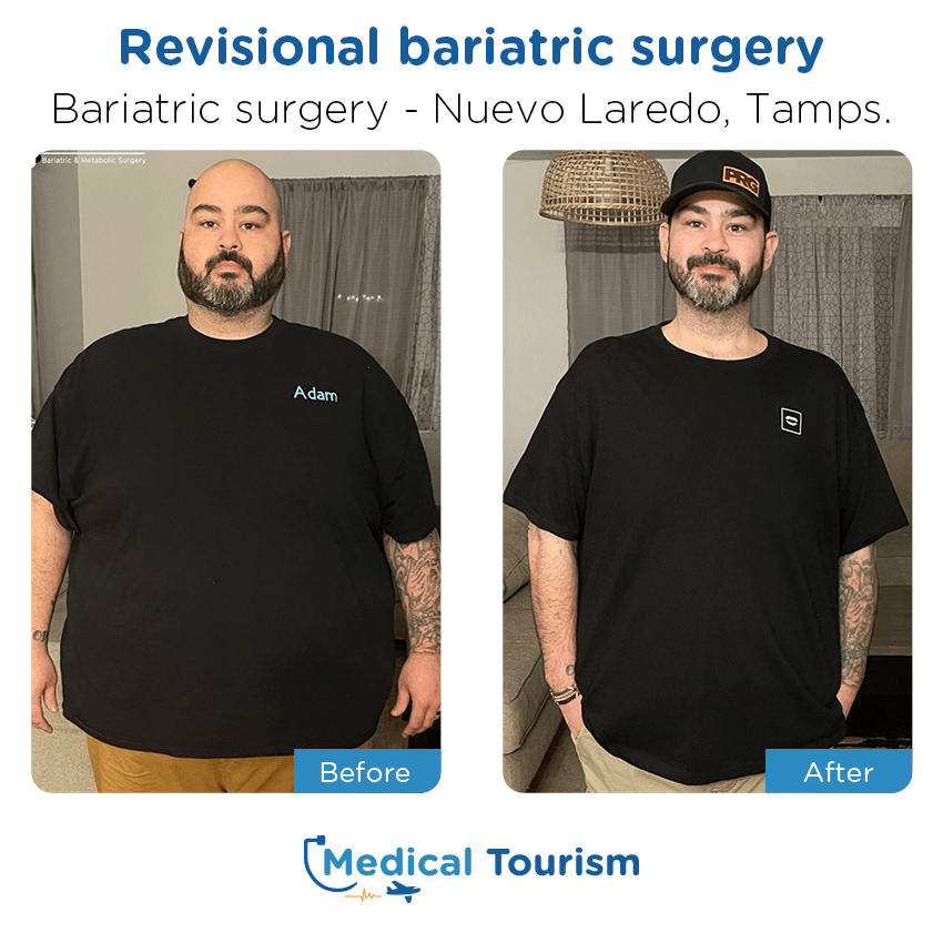 bariatric surgery before and after of patients in Nuevo Laredo