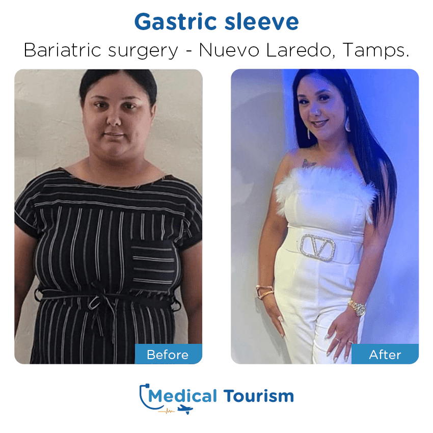 bariatric surgery before and after of patients in Nuevo Laredo
