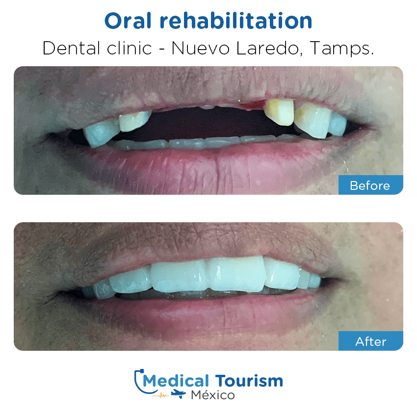 Patient before and after medical tourism