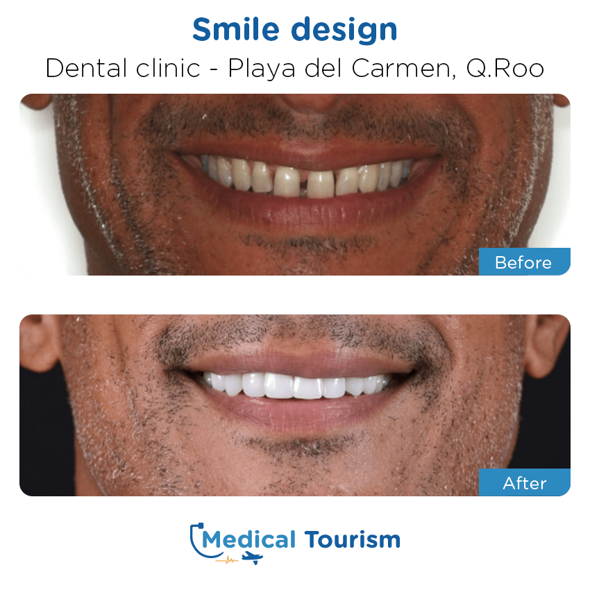 dental before and after of patients in Playa del Carmen