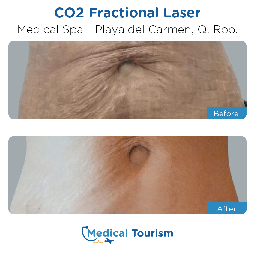 aesthetic medicine before and after of patients in Playa del Carmen