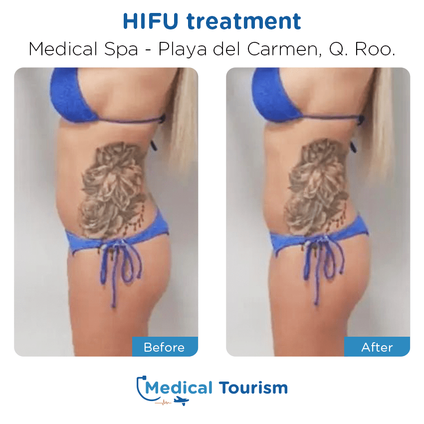 aesthetic medicine before and after of patients in Playa del Carmen