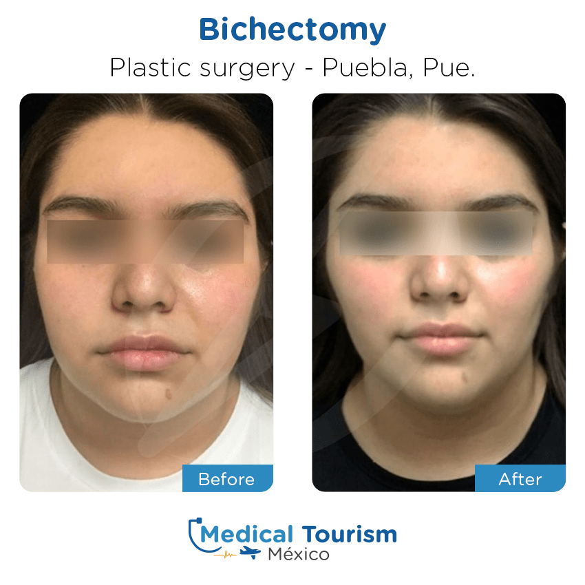 plastic surgery before and after of patients
                 in Puebla
