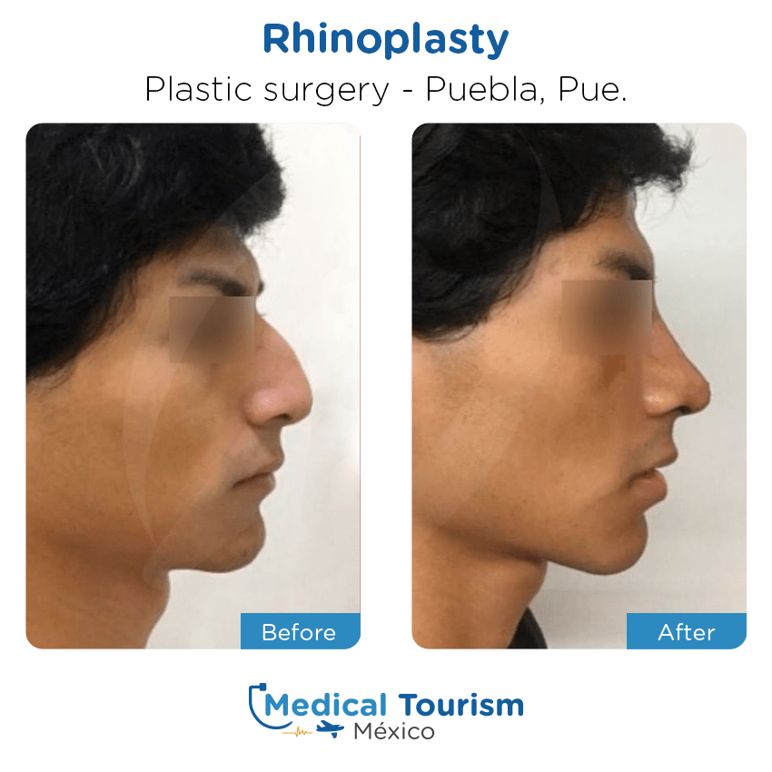 plastic surgery before and after of patients in Puebla