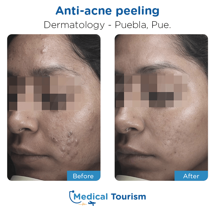 dermatology before and after of patients in Puebla