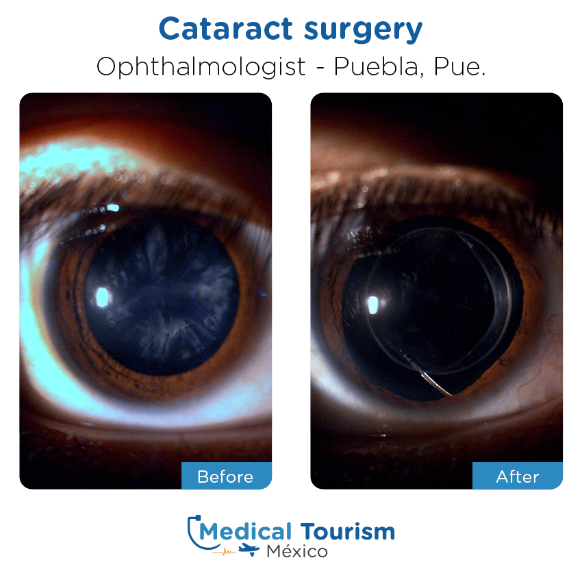 ophthalmology before and after of patients in Puebla