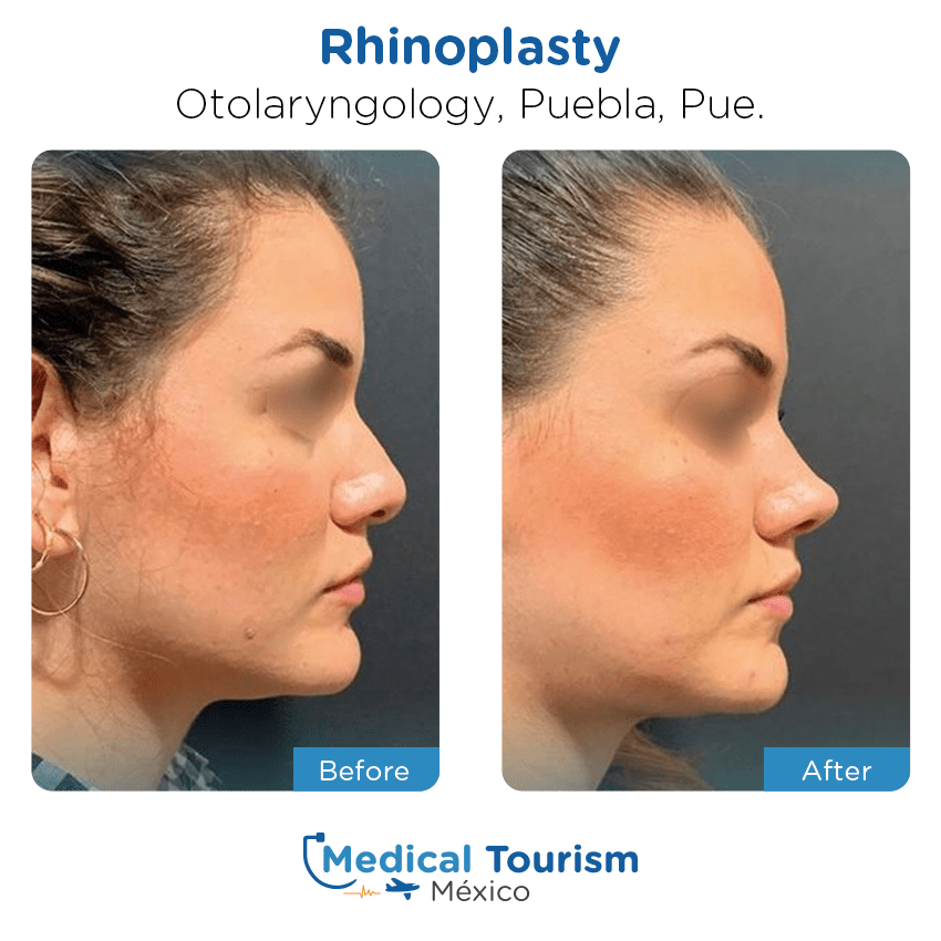 otolaryngology - ENT before and after of patients
                 in Puebla