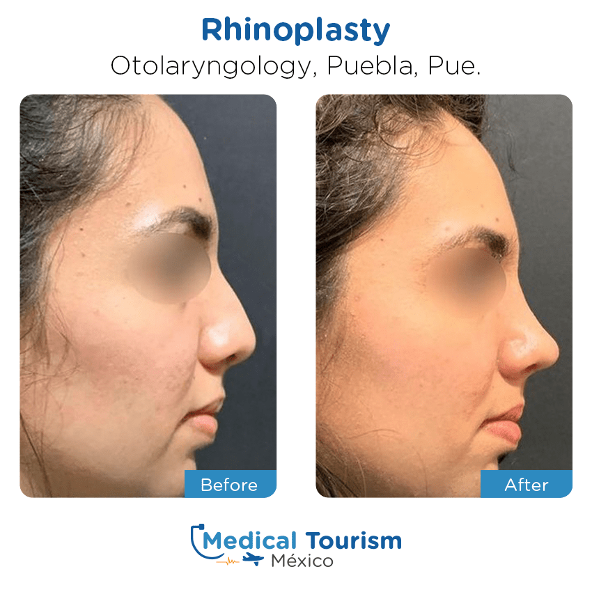 otolaryngology - ENT before and after of patients in Puebla