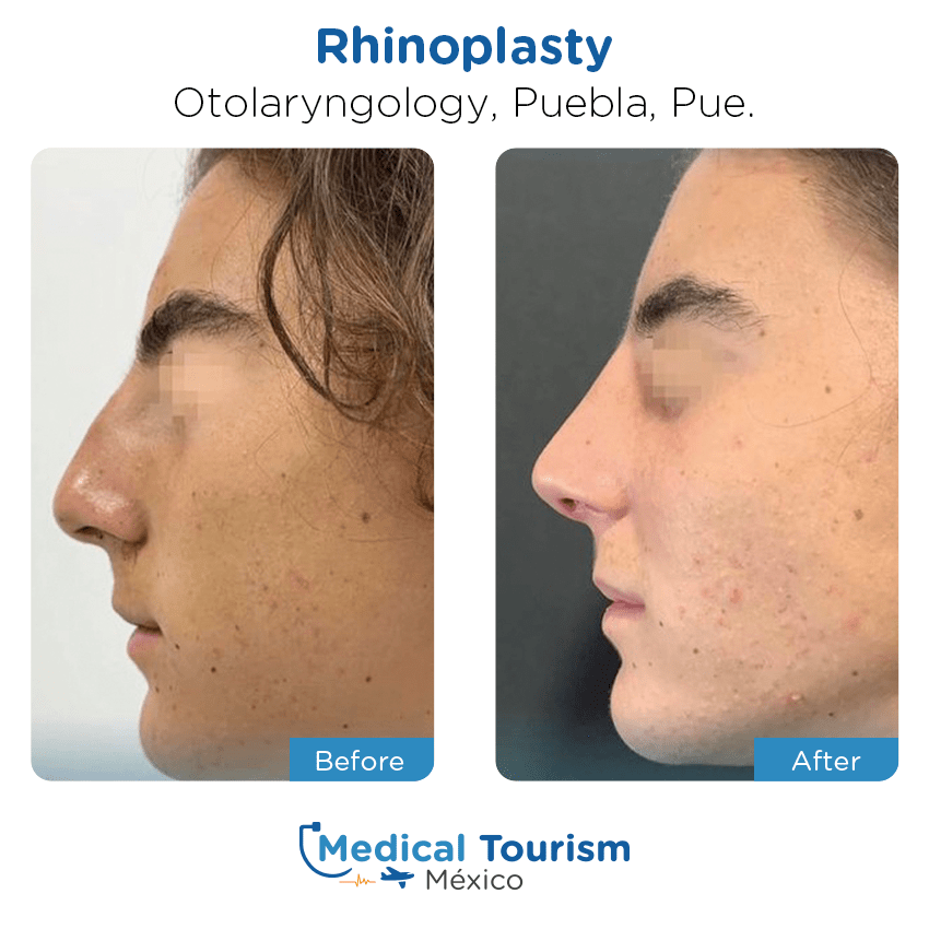 otolaryngology - ENT before and after of patients
                 in Puebla