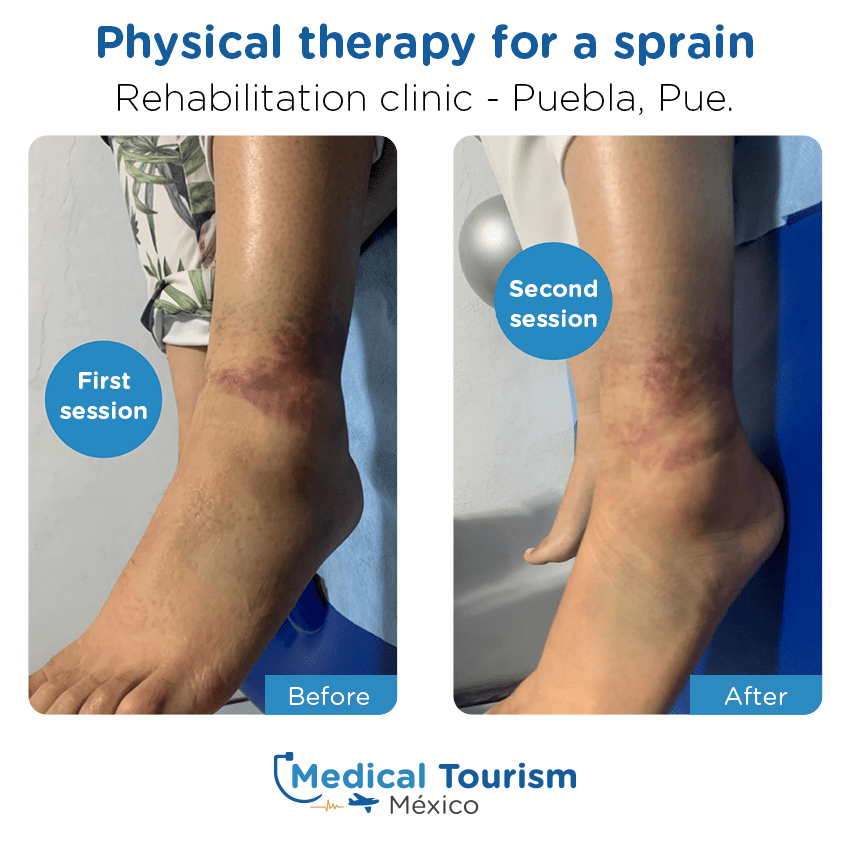 rehabilitation - physical therapy or chiropractic before and after of patients
                 in Puebla