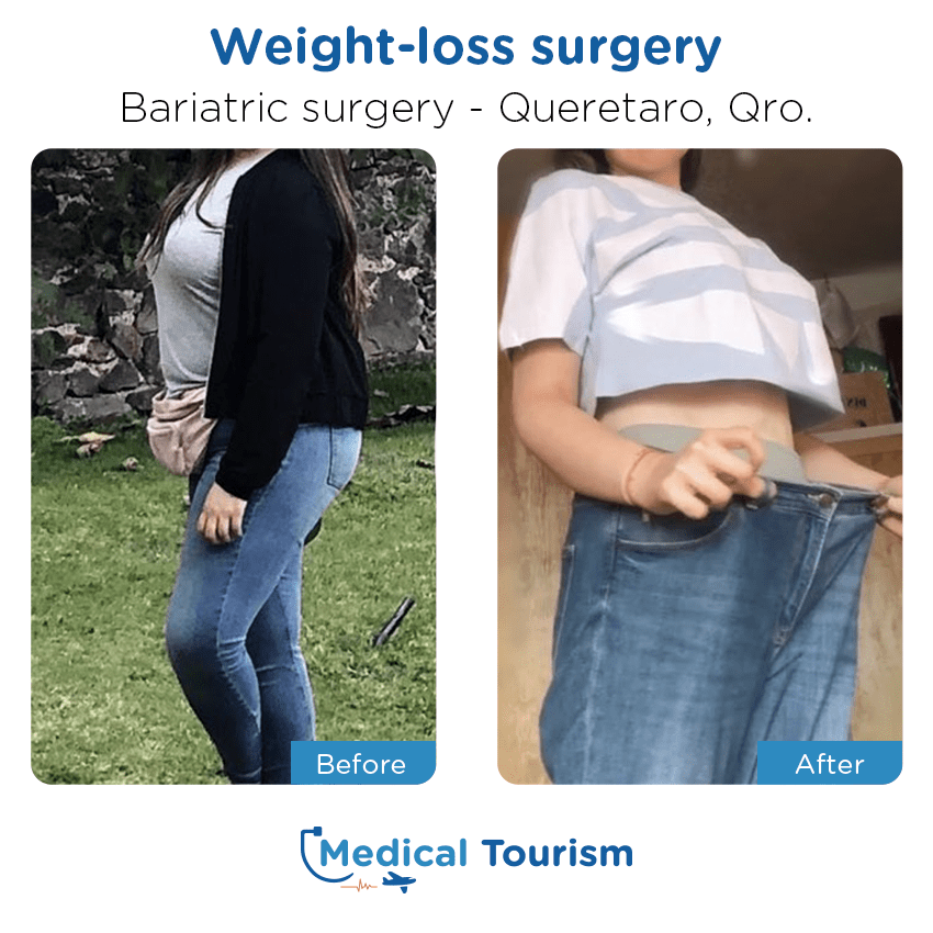 bariatric surgery before and after of patients in Querétaro
